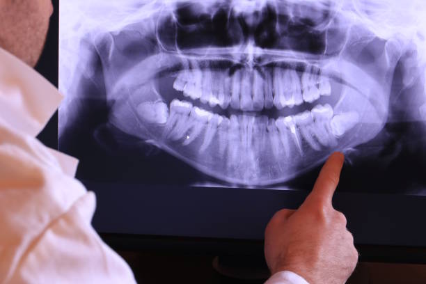 Best Knocked-Out Tooth (Avulsed Tooth) Treatment in Lewisville, TX